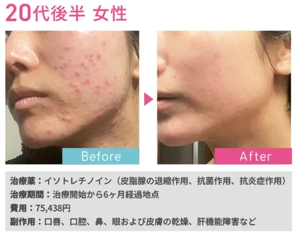 ニキビ オンラインクリニック,ニキビ オンライン診療,イソトレチノイン