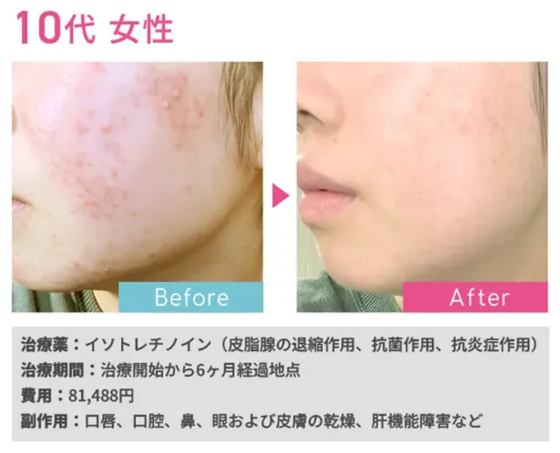 ニキビ オンラインクリニック,ニキビ オンライン診療,イソトレチノイン