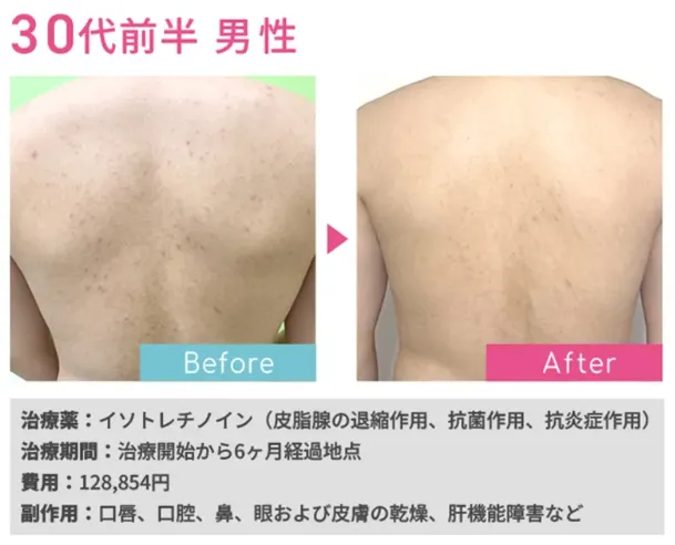 ニキビ オンラインクリニック,ニキビ オンライン診療,イソトレチノイン